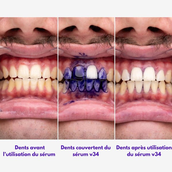 GlorySmile™- Sérum correcteur de couleur V34