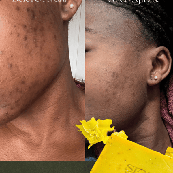 Savon Bioblean au Curcuma ✨ 💥 OFFRE SPÉCIALE : 1 acheté = 1 gratuit ! 💥 STOCK TRÈS LIMITÉ. - Hodamart