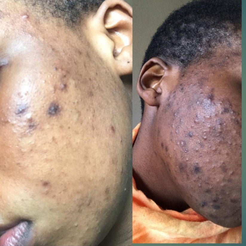 Savon Bioblean au Curcuma ✨ 💥 OFFRE SPÉCIALE : 1 acheté = 1 gratuit ! 💥 STOCK TRÈS LIMITÉ. - Hodamart